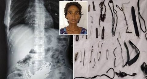 Xəstənin mədəsindən 1,5 kiloqram qayka, bolt və zinət əşyaları çıxarıldı Xəstənin mədəsindən 1,5 kiloqram qayka, bolt və zinət əşyaları çıxarıldı