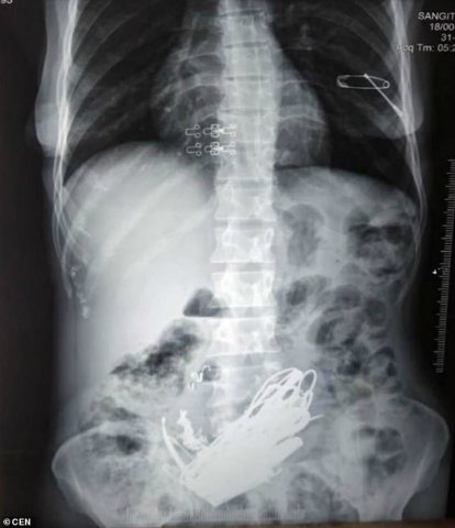 Xəstənin mədəsindən 1,5 kiloqram qayka, bolt və zinət əşyaları çıxarıldı Xəstənin mədəsindən 1,5 kiloqram qayka, bolt və zinət əşyaları çıxarıldı