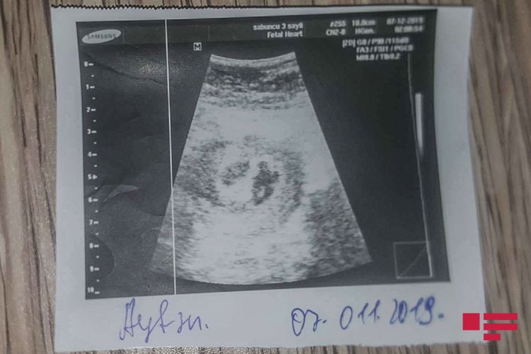 Bakıda yeni doğulan əkiz uşaqlardan birini oğurlayıblar? Bakıda yeni doğulan əkiz uşaqlardan birini oğurlayıblar?